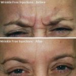 Wrinkle Free Injections Treatment 3 — Tailored Skin Care Treatments in Benowa, QLD