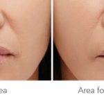 Lip Treatment — Tailored Skin Care Treatments in Benowa, QLD