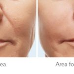 Face Treatment — Tailored Skin Care Treatments in Benowa, QLD
