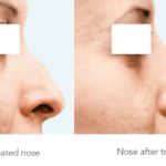Nose Treatment — Tailored Skin Care Treatments in Benowa, QLD