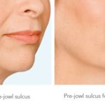 Pre-jowl Sulcus — Tailored Skin Care Treatments in Benowa, QLD
