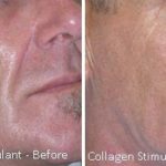 Collagen Stimulant — Tailored Skin Care Treatments in Benowa, QLD