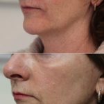 Wrinkles on Left Side of the Face — Tailored Skin Care Treatments in Benowa, QLD