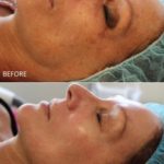 Dermal Therapy Before and After — Tailored Skin Care Treatments in Benowa, QLD