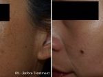 IPL Before and After — Tailored Skin Care Treatments in Benowa, QLD