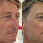 Skin Care Treatment — Tailored Skin Care Treatments in Benowa, QLD