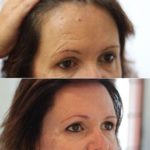 Mole Before & After Treatment — Tailored Skin Care Treatments in Benowa, QLD
