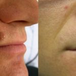 Mole Before and After Treatment — Tailored Skin Care Treatments in Benowa, QLD