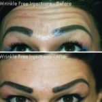 Wrinkle Free Injections Treatment 1 — Tailored Skin Care Treatments in Benowa, QLD