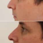 Face Before & After Treatment — Tailored Skin Care Treatments in Benowa, QLD