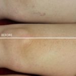 Veins Before and After Treatment — Tailored Skin Care Treatments in Benowa, QLD