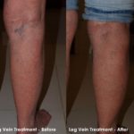 Veins Before and After Treatment — Tailored Skin Care Treatments in Benowa, QLD