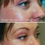 Wrinkle Free Injections Treatment — Tailored Skin Care Treatments in Benowa, QLD