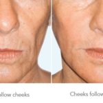 Cheeks Treatment — Tailored Skin Care Treatments in Benowa, QLD