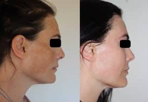 Melasma – What Is It and How Do I Get Rid of It? — Tailored Skin Care Treatments in Benowa, QLD