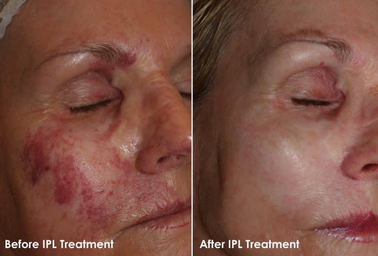 Before and After IPL Rosacea Treatment — before and after images