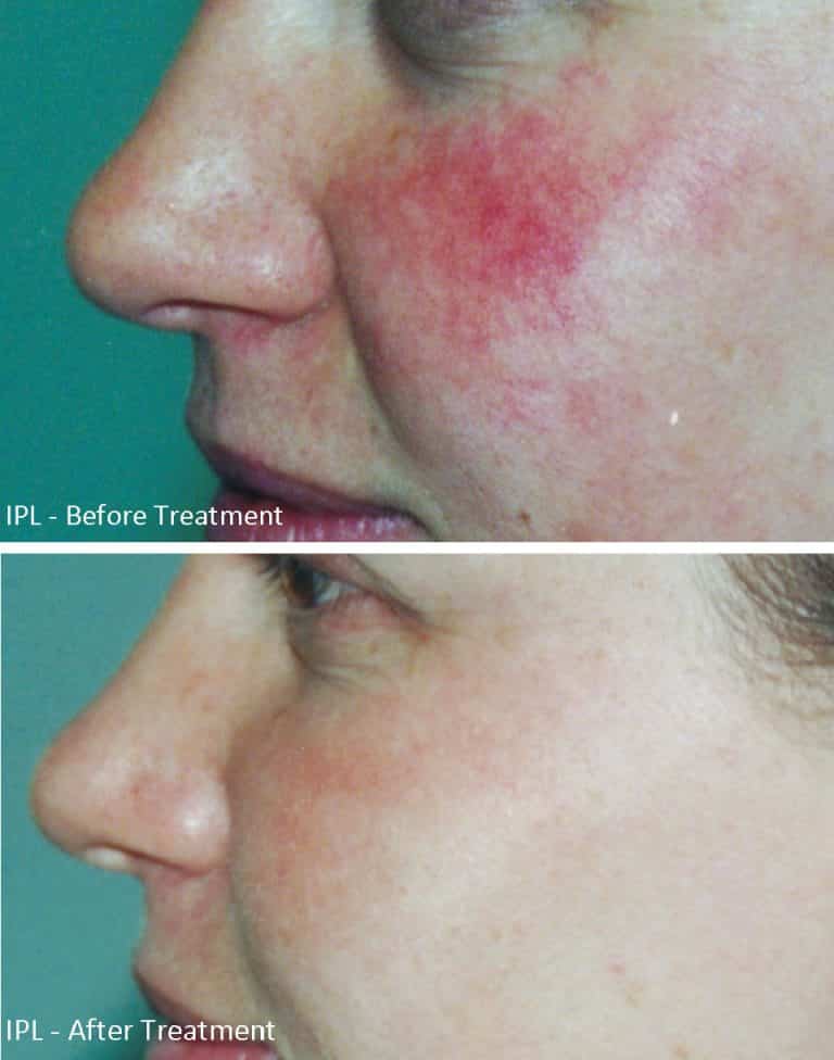 Rosacea Before and After IPL Treatment images