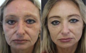 How much dermal filler do I need? — Tailored Skin Care Treatments in Benowa, QLD