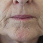 Dermal Filler Before — Tailored Skin Care Treatments in Benowa, QLD