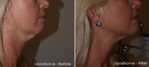 Lipodisolve Before and After — Tailored Skin Care Treatments in Benowa, QLD