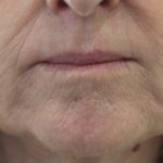 Dermal Filler After — Tailored Skin Care Treatments in Benowa, QLD