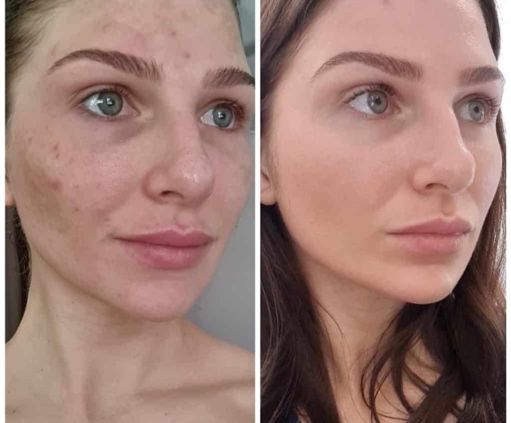 Before and After Treatment with Cosmelan Treatment