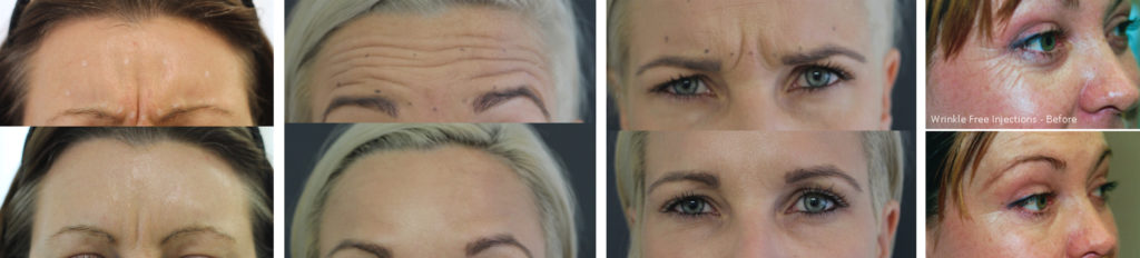 Before & After treatment Images with botox and injectables