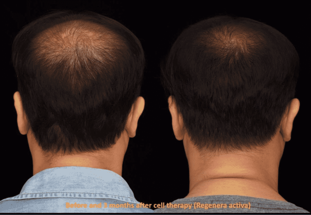 Hair Loss Treatment before and After using Regenera Activa Treatment 