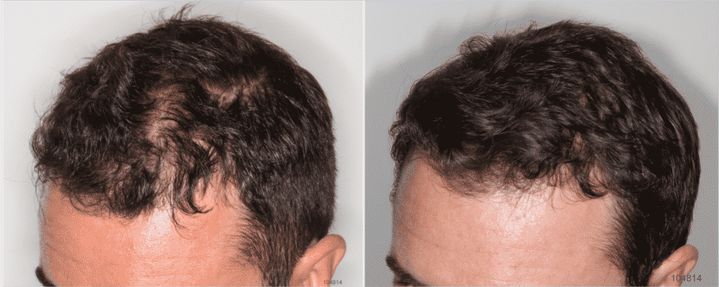 HairLoss Treatment Before and after using Regenera Activa