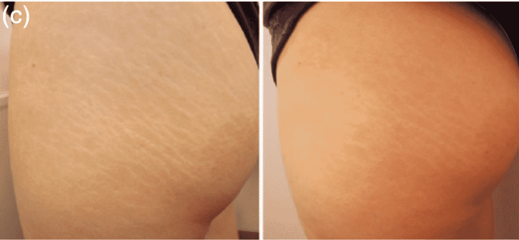 Before and after treatment by Activa Regenera  treatment for leg stretch marks