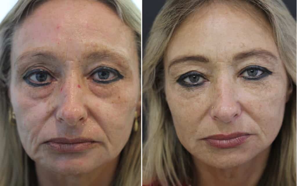 Before and after Dermal Filler midface