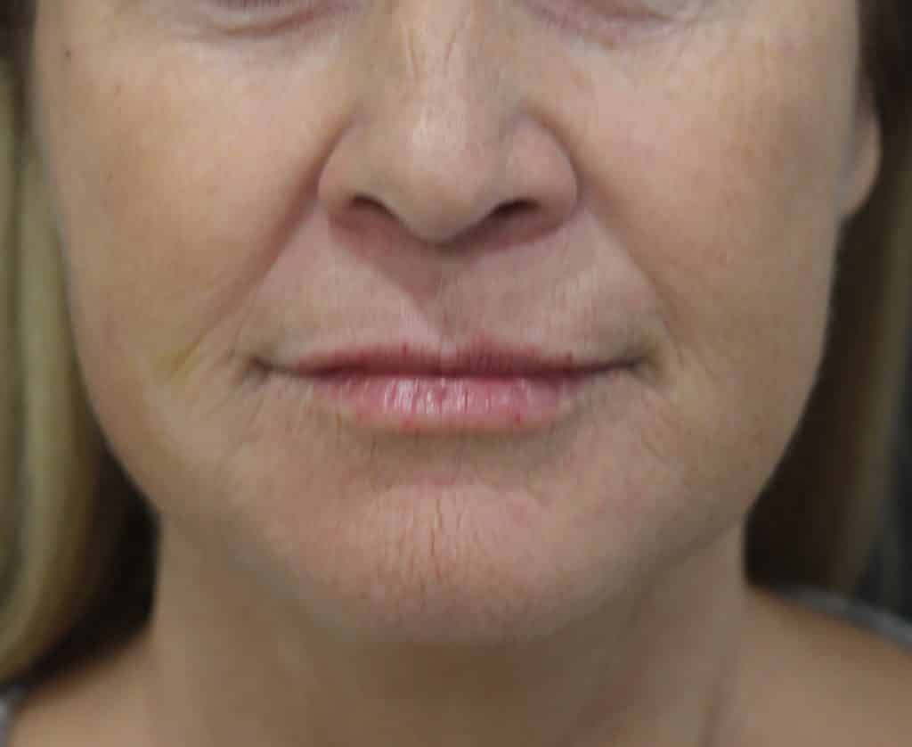 post treatment with 4.5 ml of filler