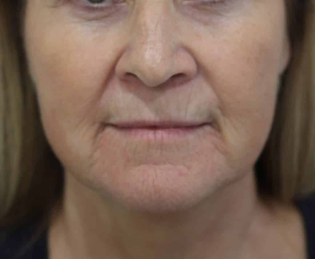 pre treatment not smiling using 4.5ml of filler