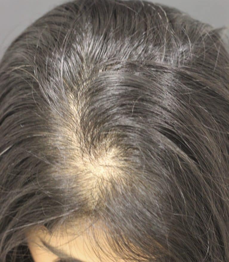 Female patient suffering Hair Loss before treatment using the regenera activa hair loss treatment