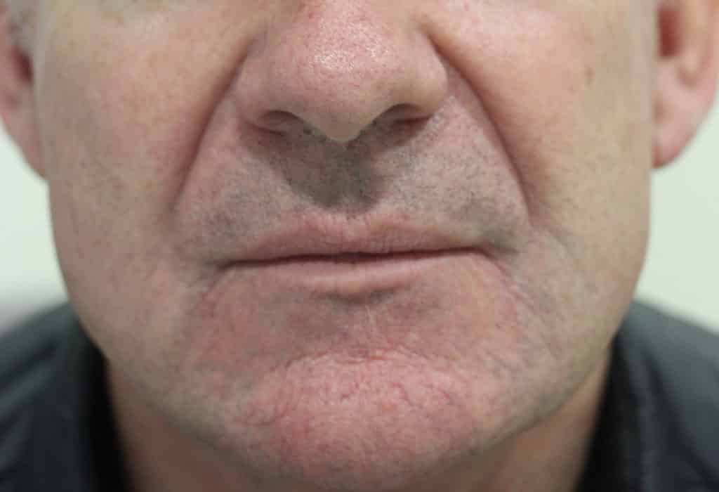 Male jawline after treatment using croma plus and filler