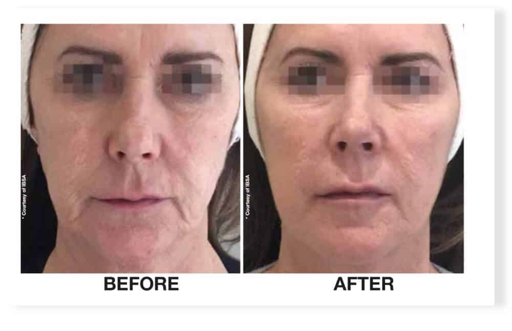 Before and After Treatment with Honey Filler Profhilo