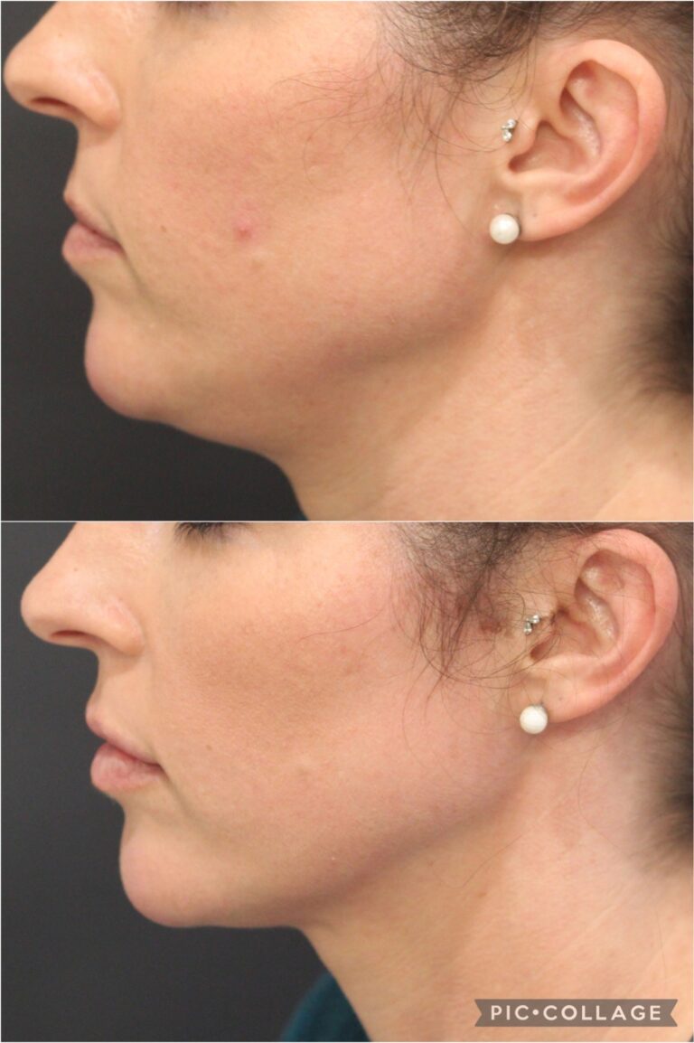 Thread Lift Treatment now available at Envisage Clinic Gold Coast