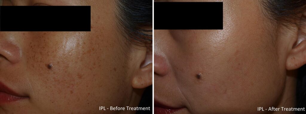 Skin Before And After IPL Treatment