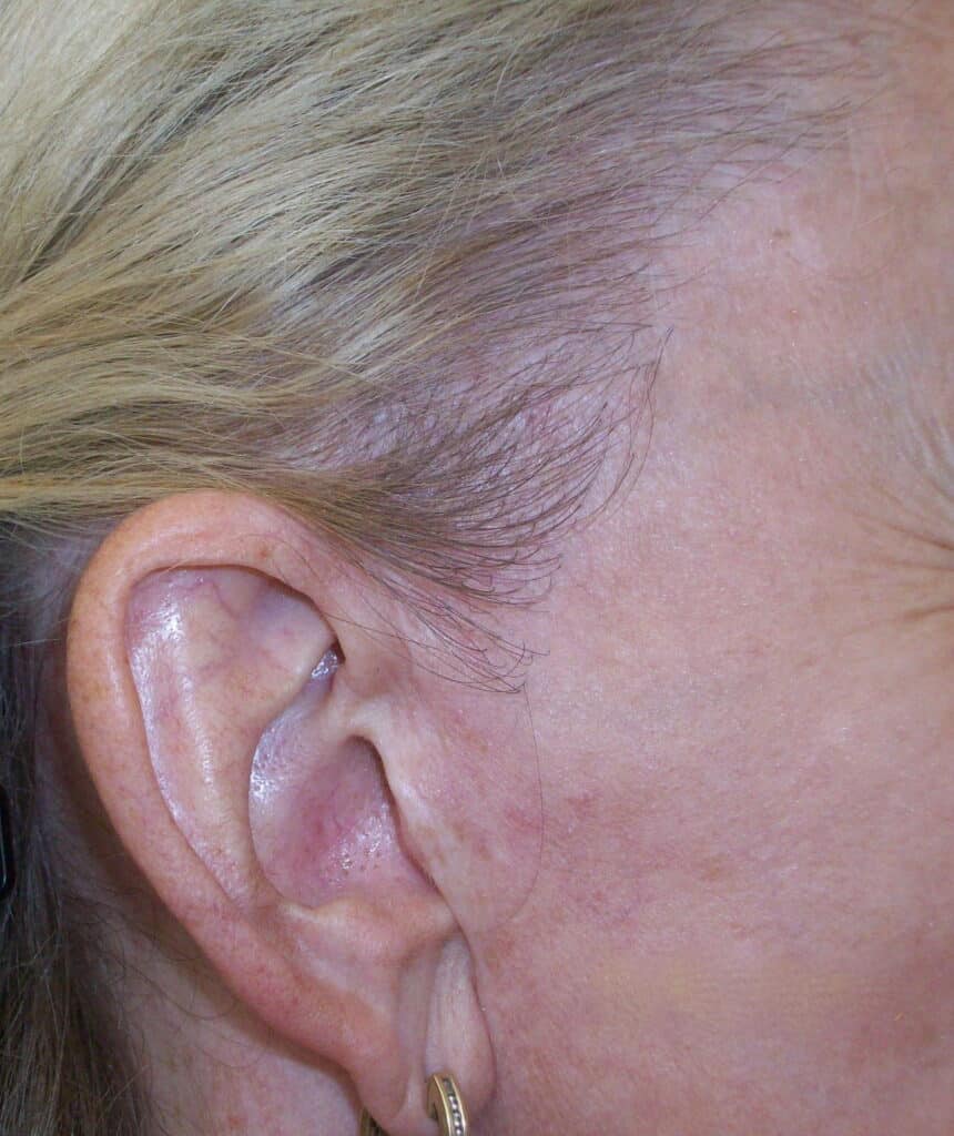 Female patient of Dr leat After hair transplant to recreate sideburns after face lift surgery - Womens hair loss treatment - Dr Chris Leat Envisage Clinic - Broadbeach