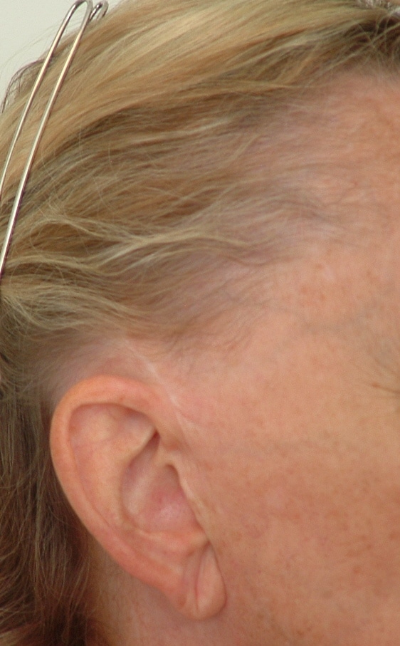Female patient of Dr leat Before hair transplant to recreate sideburns after face lift surgery - Womens hair loss treatment - Dr Chris Leat Envisage Clinic - Broadbeach