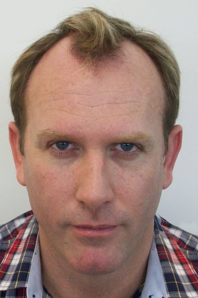 Geoffrey a patient of Dr Leat before having hair loss treatment - Hair transplant Gold Coast - Dr Leat is a fully qualified medical professional doctor. Book your free consultation Envisage Ashmore GC