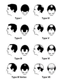 Male and female pattern hair loss stages