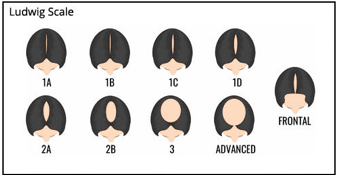 Female Hair Loss