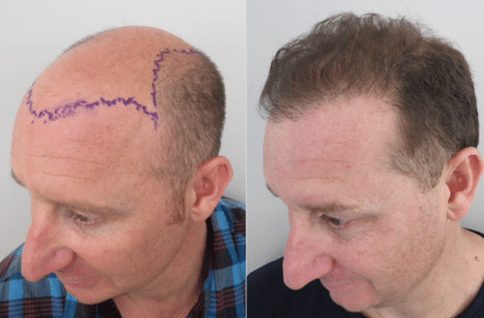 Male Hair Loss Restoration - Before and After Treatment with Regenera Activa