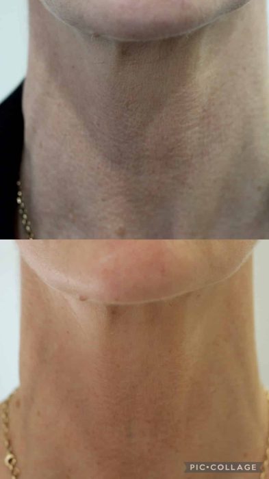 Neck front before & after one treatment with Honey Filler