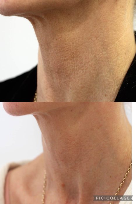 Neck side before & after one treatment with Honey Filler at Envisage Clinic Ashmore